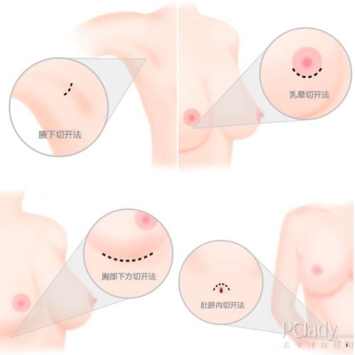 催眠隆胸? 2招医美丰胸术终极PK - 百科教程网