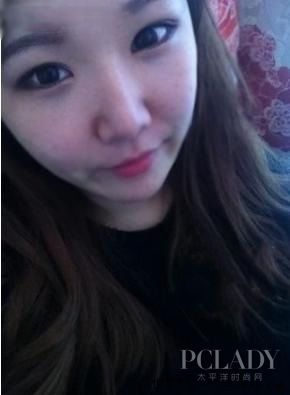 整形美容割双眼皮 术后一年变化 - 百科教程网