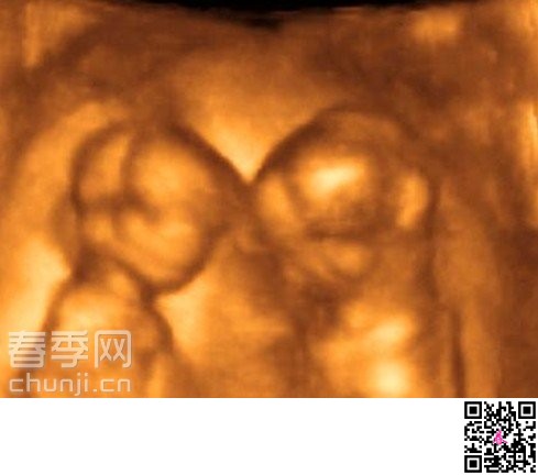警惕:双胞胎在子宫内会掐架 抢血可致死 - 百科