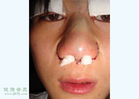 女子割双眼皮兼隆鼻全过程 - 百科教程网_经验