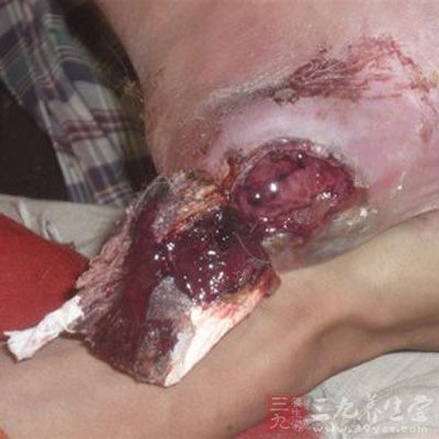        棘球蚴病(echinococcosis)又称包虫病,是人