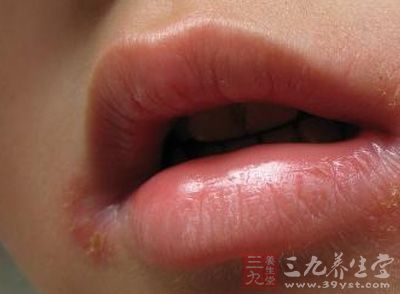 烂嘴角怎么办 不妨吃点黄豆芽来预防 - 百科教