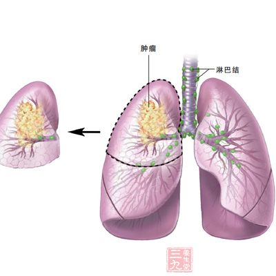 深圳肺癌成头号杀手 女性高发期比男性早15年