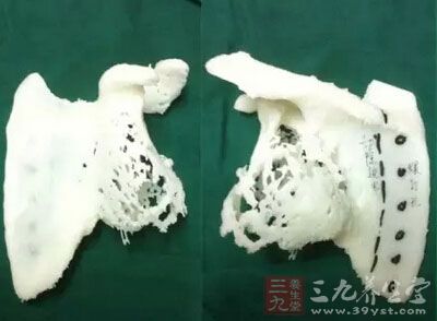 深圳首次运用3D打印技术为患者换肩 - 百科教