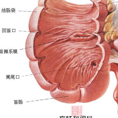 阑尾炎手术_阑尾炎是怎么引起的