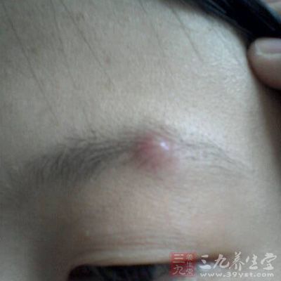 眉毛里<em>长痘痘</em> 眉毛里<em>长痘痘</em>有哪些原因 - 百科