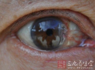 女子屏幕看久了眼中长出赘肉 - 百科教程网_经