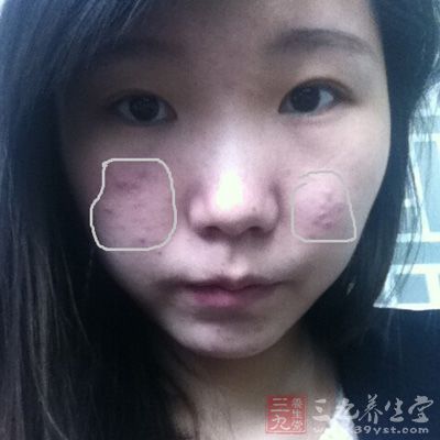 中药祛痘 安全有效快速祛痘方法大全 - 百科教