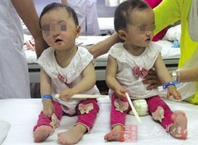 河南双胞胎女童患怪病 头颅畸形手脚像鸭蹼 