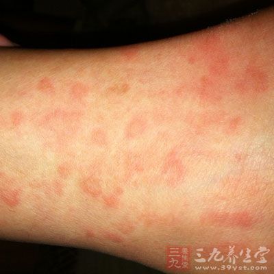 皮肤出现它竟是癌症晚期 - 百科教程网_经验分