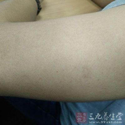治疗干燥综合症偏方 干燥综合症的症状