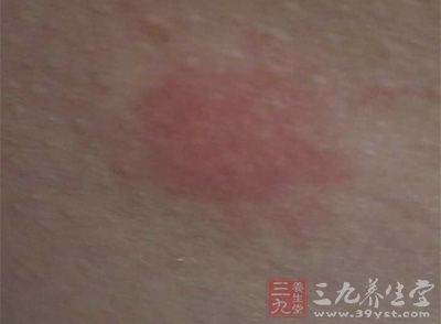 神经性皮炎的症状 如何诊断这些症状