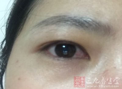 得了红眼病多久才能好 红眼病要几天才能痊愈