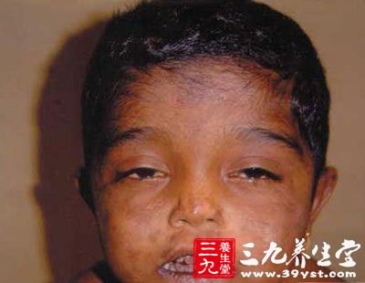 17岁怪病女孩存男性化特征十大全球罕见病症