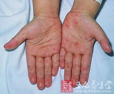 患者得了风湿性关节炎会出现什么症状 - 百科教